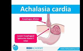 Image result for akcalosis