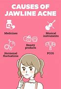 Image result for Acne On Jawline