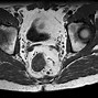 Image result for 2 Centimeter Tumor