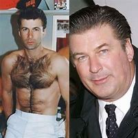 Image result for Alec Baldwin Surgery