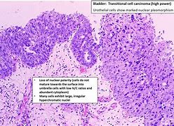 Image result for Transitional Cell Carcinoma Histology