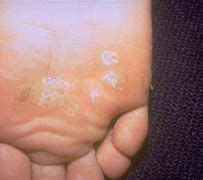 Image result for Different Types of Plantar Warts