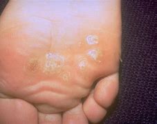 Image result for Are There Different Types of Warts