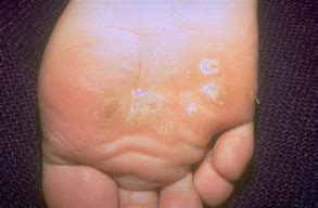 Image result for White Spots On Foot