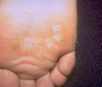 Image result for Plantar Warts On Feet