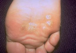 Image result for Flat vs Common Wart