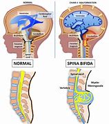 Image result for What Is Spina Bifida