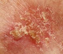 Image result for Squamous Cell Carcinoma Skin Cancer Treatment