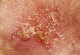 Image result for Dermatology Skin Cancer