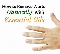 Image result for Essential Oils Wart Removal