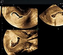 Image result for 3.5 Cm Fibroid Tumor