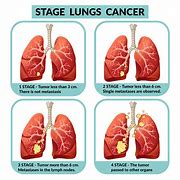 Image result for Stages of Cancer Cell