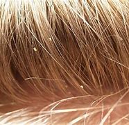 Image result for What Does a Lice Look Like Picture