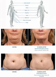 Image result for CoolSculpting Double Chin Before and After