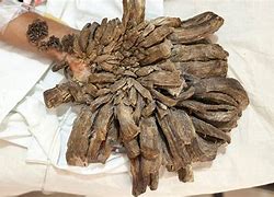 Image result for Tree Man Syndrome Feet