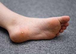 Image result for Filiform Wart On Toe