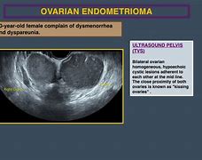 Image result for Endometrioma On Ultrasound