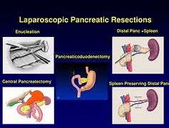 Image result for Laparoscopic Pancreatic