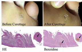 Image result for Wart Disection