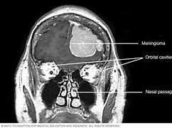 Image result for Meningioma CT Scan