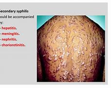 Image result for Gonorrhea Lesions