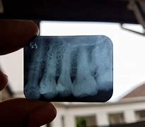 Image result for Over Exposed Dental Film