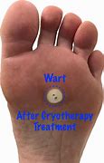 Image result for Plantar Wart Cryotherapy