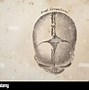 Image result for Fetal Anencephaly