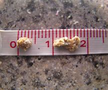 Image result for 4Mm Stone in Kidney
