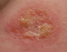 Image result for Scab Under Skin