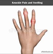 Image result for Swollen Knuckle On Middle Finger