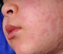 Image result for Urticaria On Face