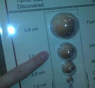 Image result for How Big Is 5 Cm Cyst
