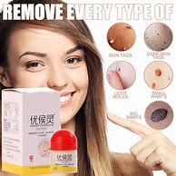 Image result for Skin Warts Treatment