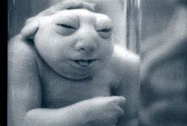 Image result for Sad Anencephaly