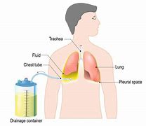 Image result for Chest Tube Removal