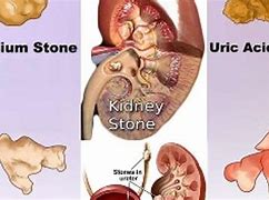 Image result for Human Kidney Stones
