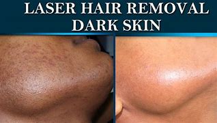 Image result for Laser Hair Removal Dark Skin