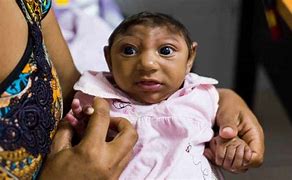 Image result for Zika Babies