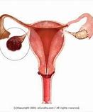 Image result for Largest Ovarian Tumor