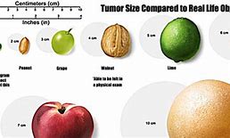 Image result for How Big Is 6 Cm Tumor