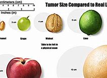Image result for Tumor Sizes in Centimeters