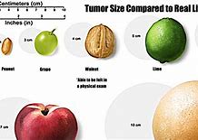 Image result for 2 Cm Tumor Size Of