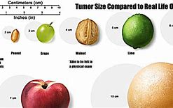 Image result for 2 Cm Tumor