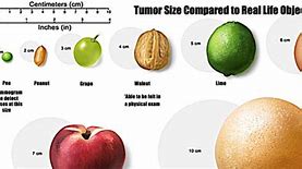 Image result for How Big Is a 20 Cm Tumor