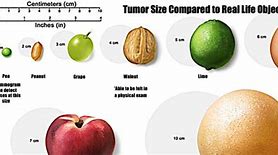 Image result for 2 Cm Tumor Size Of