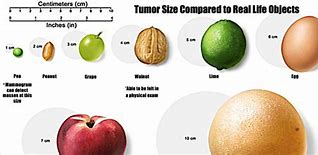Image result for How Big Is 2 Cm Tumor
