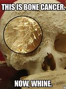 Image result for Sarcoma Bone Cancer Skull