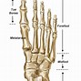 Image result for Jones Fracture X-ray