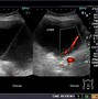 Image result for Cystadenomas Ovarian Cyst Ultrasound